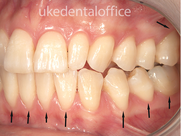 歯肉移植の治療例10 左側（施術前）