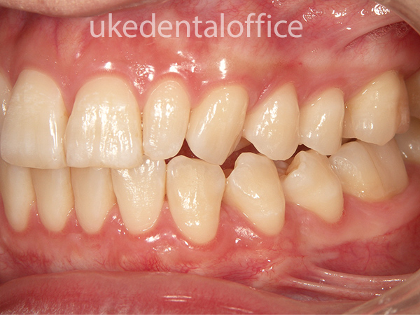 歯肉移植の治療例10 左側（施術後）