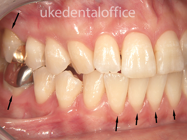 歯肉移植の治療例10 右側（施術前）