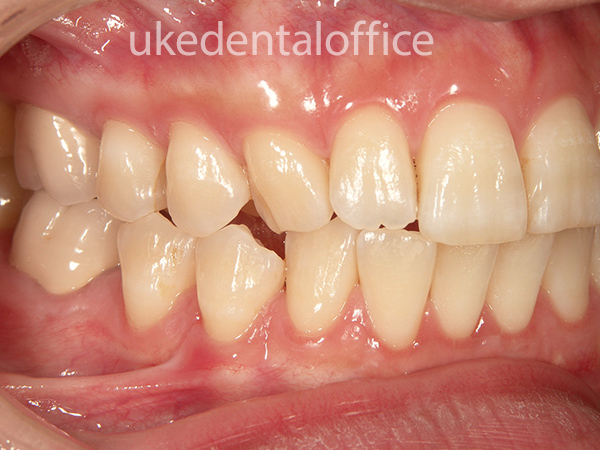 歯肉移植の治療例10 右側（施術後）