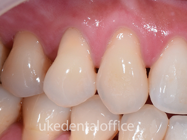 歯周整形治療 側方移植術 施術前 右側