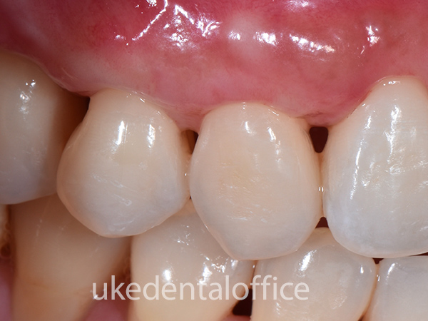 歯周整形治療 側方移植術の施術後 右側