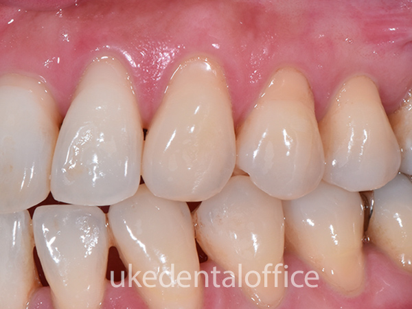 歯周整形治療 側方移植術の施術前 左側
