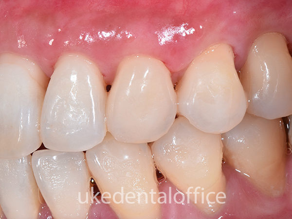 歯周整形治療 側方移植術の施術後 左側