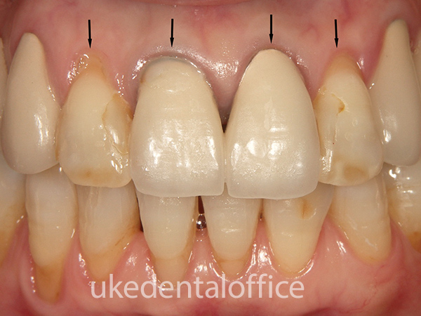 歯肉移植の治療例15（施術前）