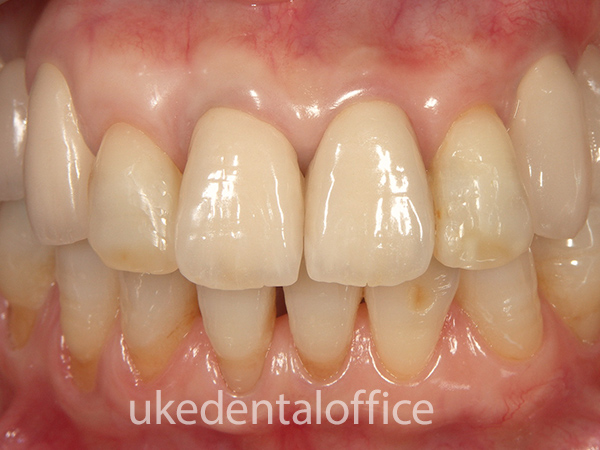 歯肉移植の治療例15（施術後）