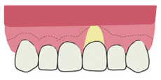 歯肉退縮（歯槽粘膜に達する）