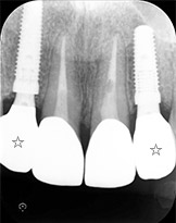 骨再生療法、歯肉移植を伴うインプラントとソケットシールドインプラント治療例（インプラント部分拡大）