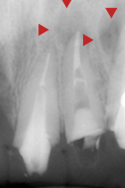 根尖性歯周炎のMTAセメントを用いた根管治療例④（術前1）