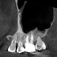 根尖性歯周炎のMTAセメントを用いた根管治療例①（術後1年-2）
