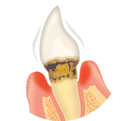 中等度歯周病のイラスト（歯周ポケット4～6mm）