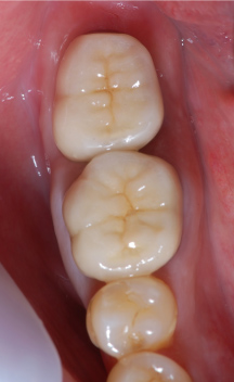 歯の移植の治療前後の写真