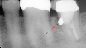 レントゲンから見たアマルガム