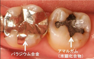 パラジウム合金とアマルガム(水銀化合物)