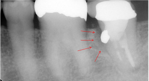アマルガム周囲の骨が溶けている