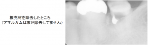 根充材を除去箇所(アマルガム除去前)