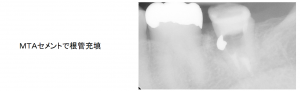 MTAセメントで根管充填