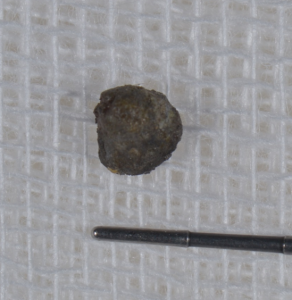 除去したアマルガム