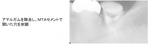 アマルガムを除去し、MTAセメントで開いた穴を封鎖