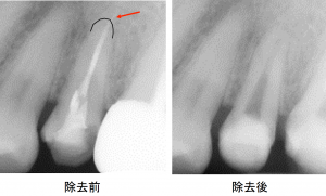 OKマイクロエキスカ0.2ミリを使用した症例