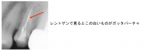レントゲンから見るガッタパーチャ
