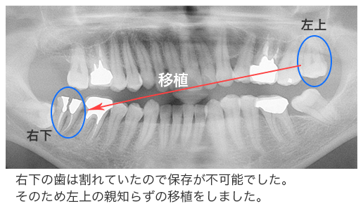 親知らず移植症例1
