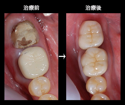 親知らず移植症例3