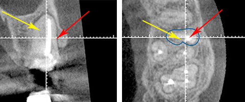 隠れた根管 隠れた根管