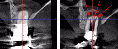 blog05_2 珍しい根管MB3の断面図