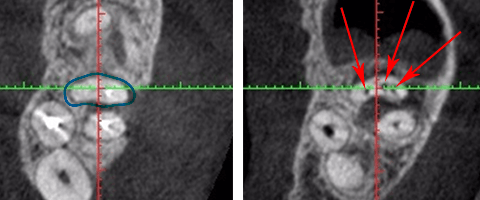 blog05_3 珍しい根管MB3
