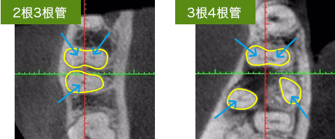 blogimage01 下顎第一大臼歯の根管