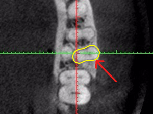 blogimage02 非常に珍しい形態をもつ下顎第一大臼歯