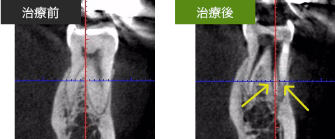 blogimage03 珍しい根管治療症例