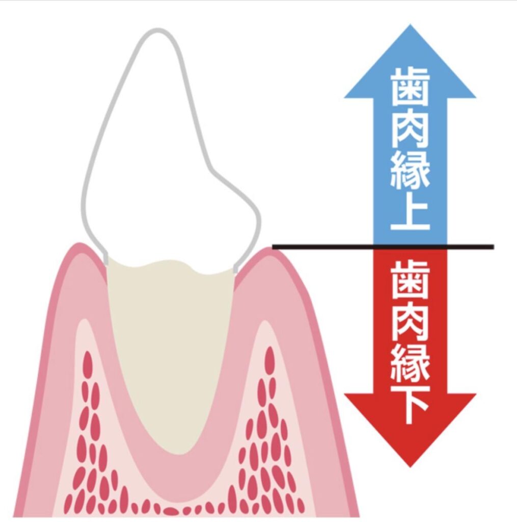 歯ぐきより上の歯石と歯ぐきの中の歯石の違い