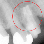 歯根端切除の症例写真