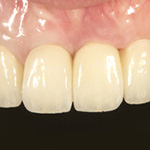 前歯インプラントの症例写真