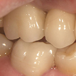 臼歯インプラントの症例写真
