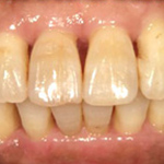 歯周病治療の症例写真