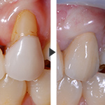 歯周組織再生療法の症例写真