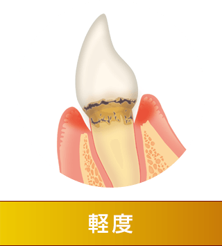 軽度の歯周病