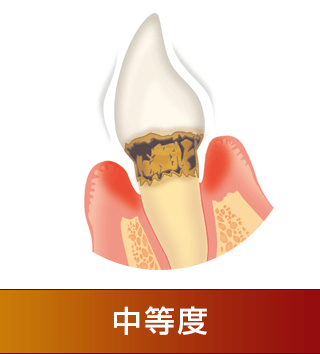 中等度の歯周病