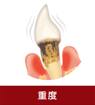 重度の歯周病