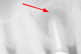 歯根端切除を伴う根管治療例②（施術前）