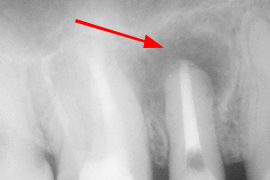 歯根端切除を伴う根管治療例②（MTAセメント充填後）