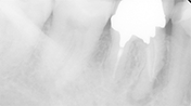 歯根端切除を伴う根管治療例③（施術前）