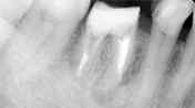 歯根端切除を伴う根管治療例③（充填後）