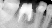 歯根端切除を伴う根管治療例③（施術後）
