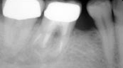 歯根端切除を伴う根管治療例④（施術前）