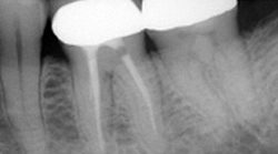 歯髄炎・根尖性歯周炎のニッケルチタンファイルによる治療例（施術前）