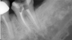 歯髄炎・根尖性歯周炎のニッケルチタンファイルによる治療例（根充後）